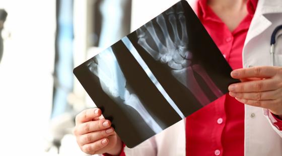 A close-up of a hand x-ray being held up and examined by a doctor