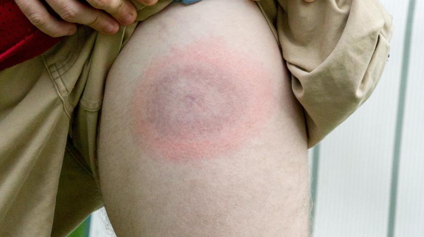 An EM Lyme disease rash on a man's leg